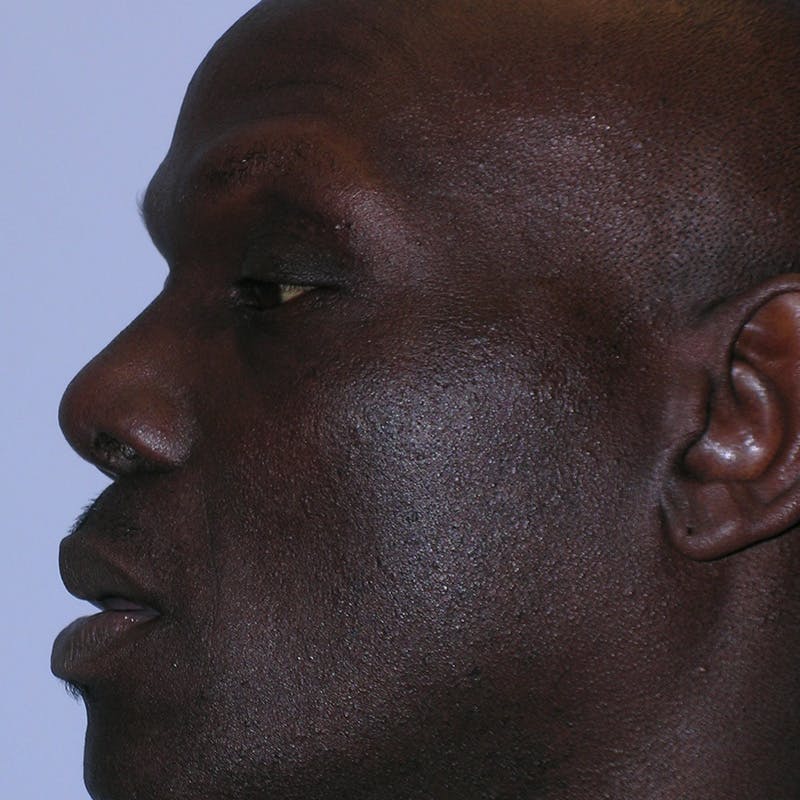 Wide Nose Before & After Gallery - Patient 129259 - Image 10