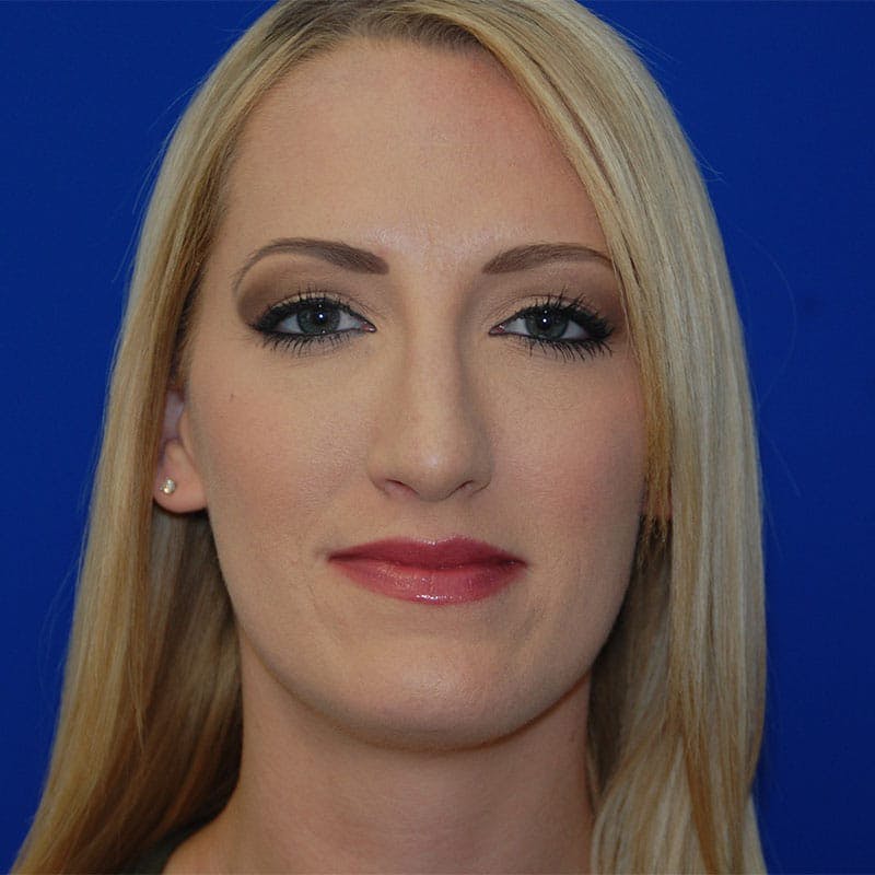 Long Nose Before & After Gallery - Patient 151681 - Image 2