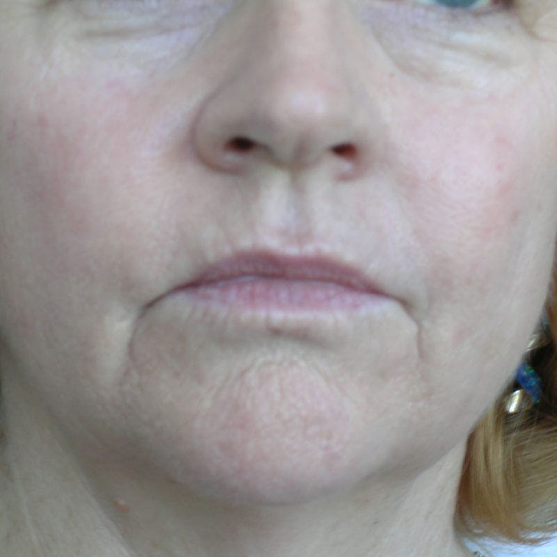 Lip Filler Before & After Gallery - Patient 307842 - Image 1