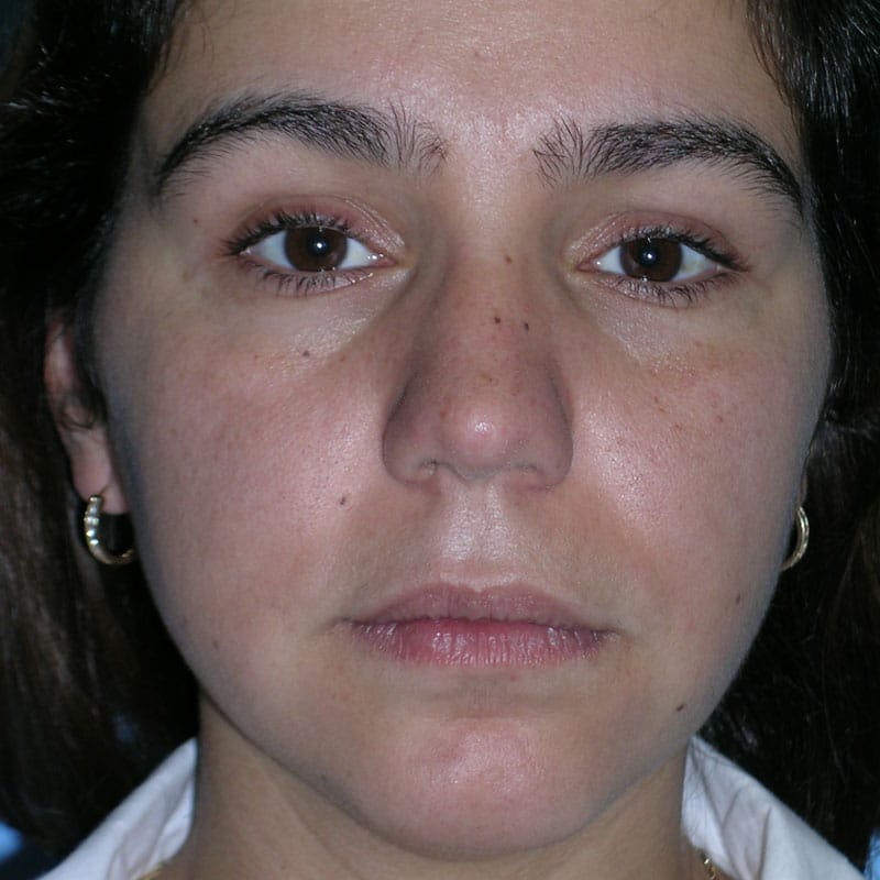 Long Nose Before & After Gallery - Patient 292085 - Image 2