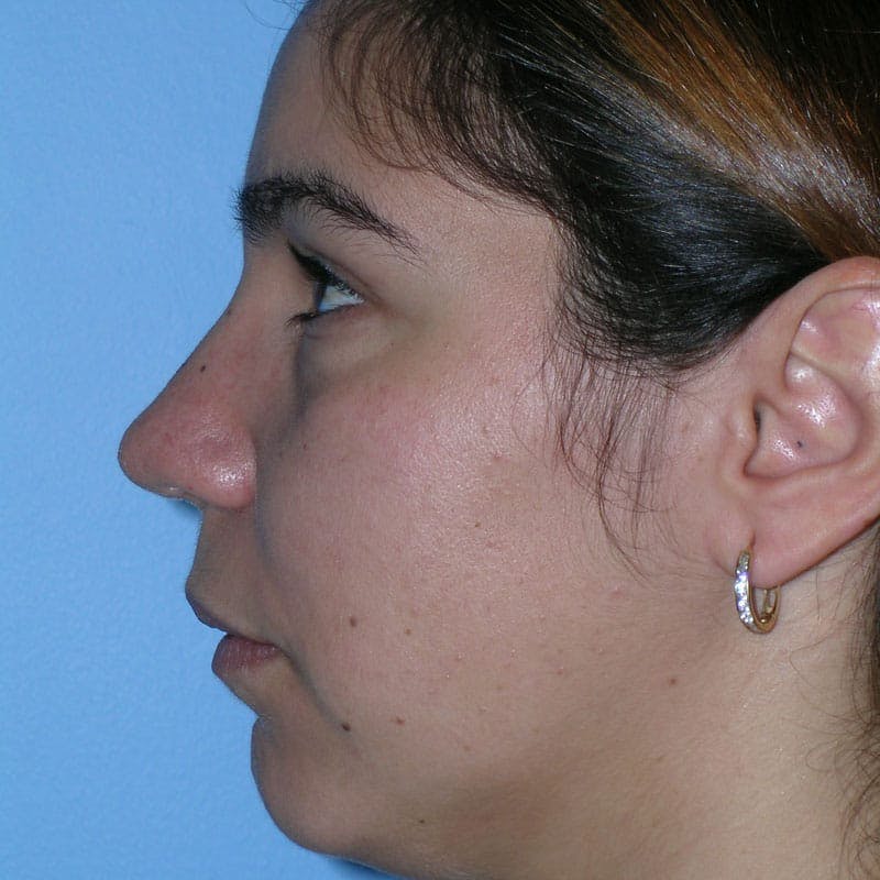 Long Nose Before & After Gallery - Patient 292085 - Image 6