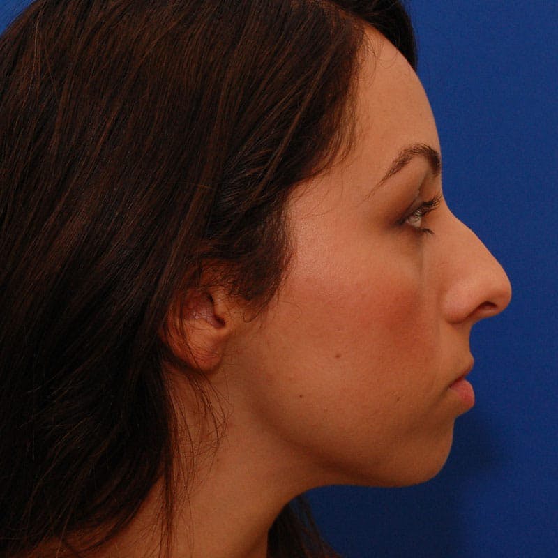 Wide Nose Before & After Gallery - Patient 308012 - Image 5