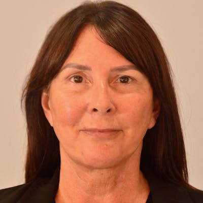 Facelift & Necklift Before & After Gallery - Patient 246000 - Image 2