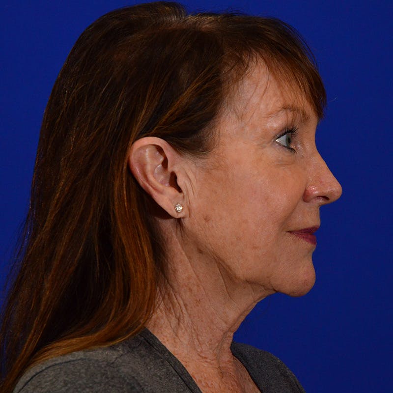 Co2 Laser Resurfacing Before & After Gallery - Patient 374474 - Image 5