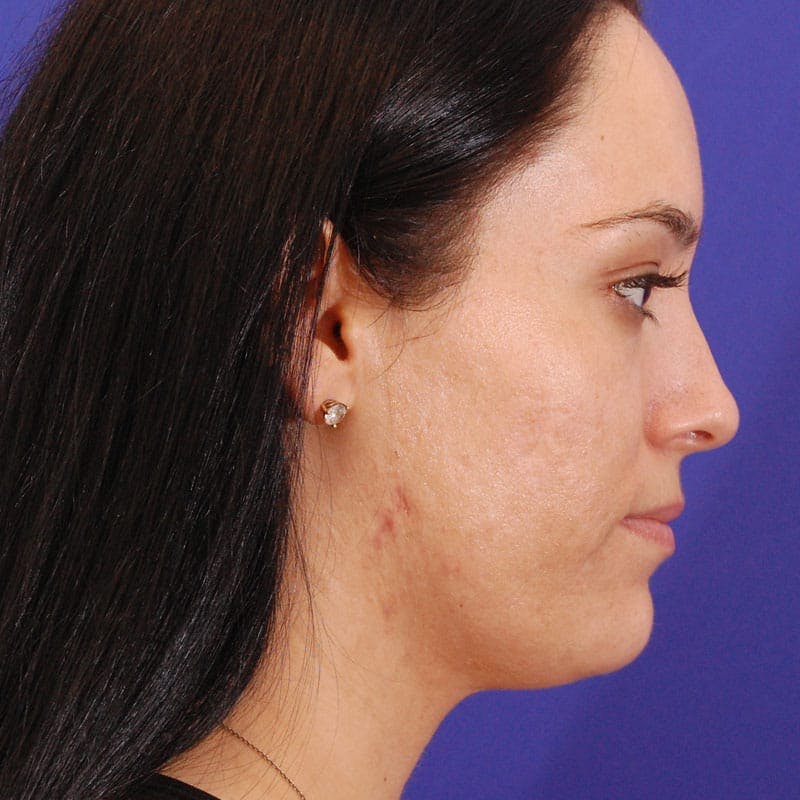 Dorsal Hump Before & After Gallery - Patient 319034 - Image 2