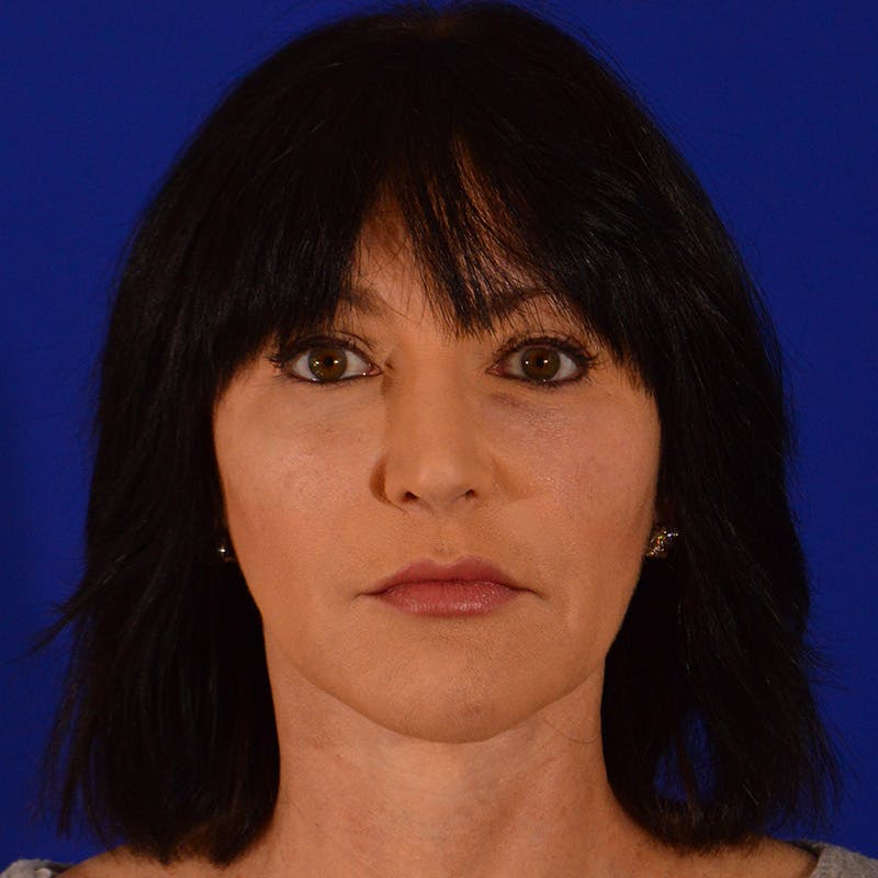Crooked Nose Before & After Gallery - Patient 158738 - Image 2