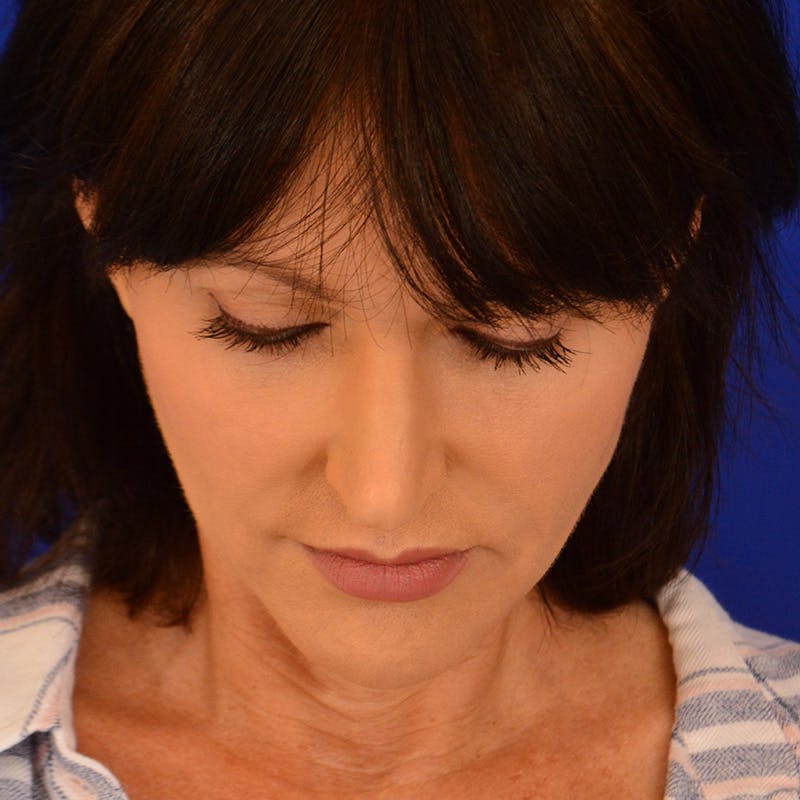 Crooked Nose Before & After Gallery - Patient 158738 - Image 13