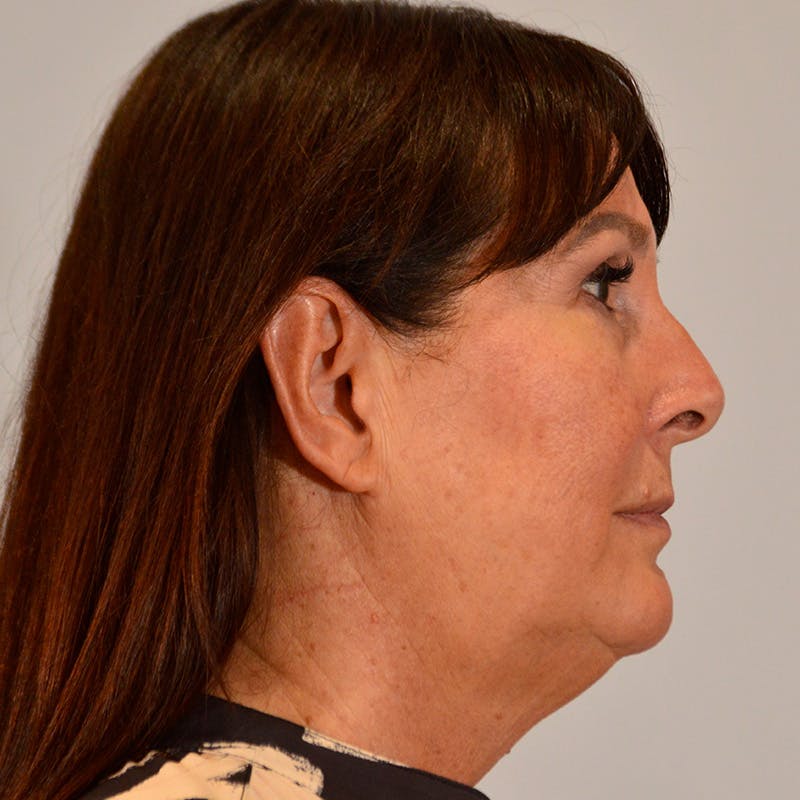 Facelift & Necklift Before & After Gallery - Patient 246000 - Image 5