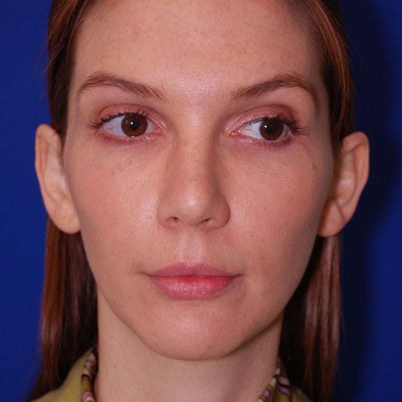 Crooked Nose Before & After Gallery - Patient 803322 - Image 2