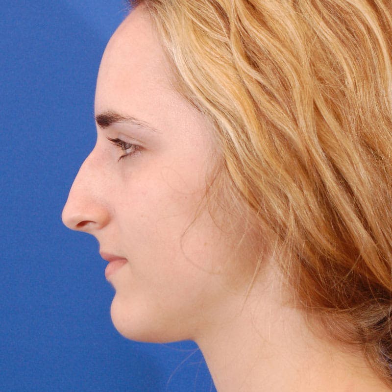 Dorsal Hump Before & After Gallery - Patient 183997 - Image 1