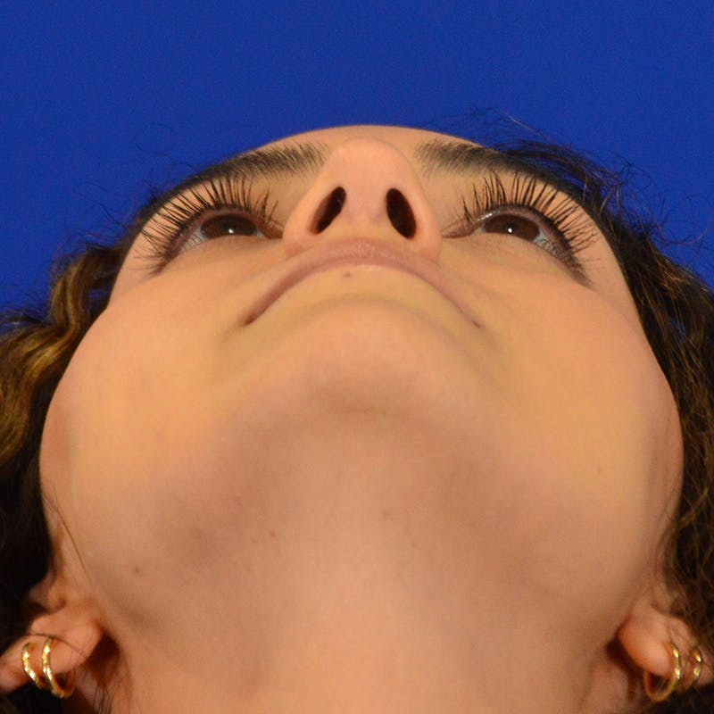 Female Rhinoplasty Before & After Gallery - Patient 224146 - Image 14