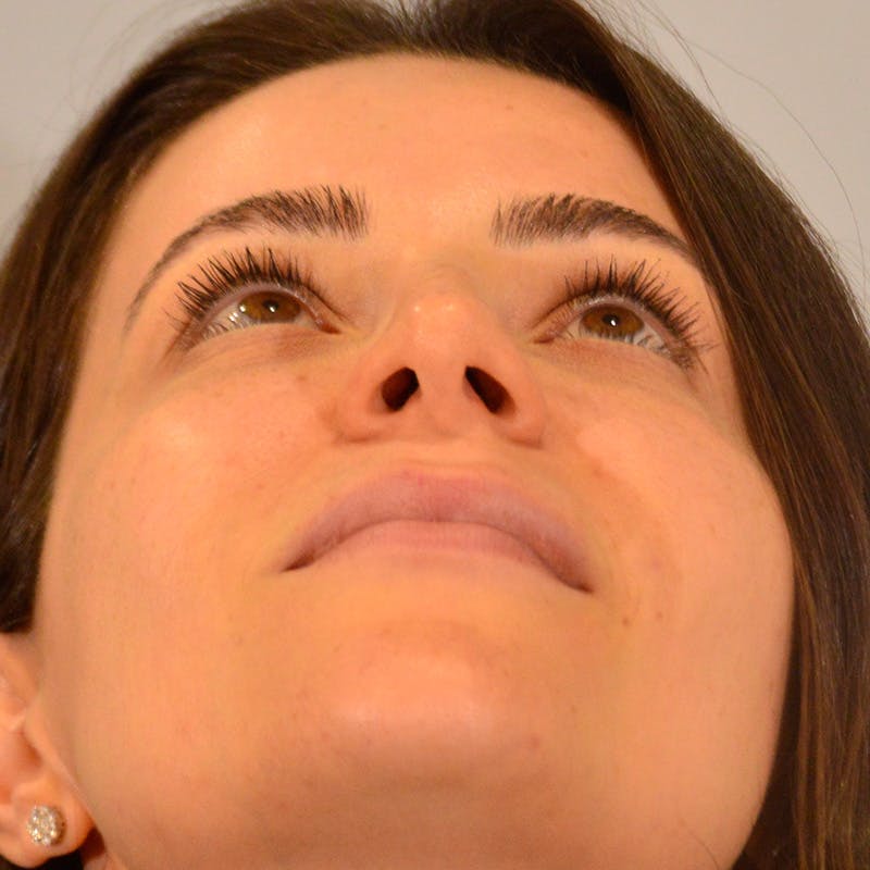 Dorsal Hump Before & After Gallery - Patient 911758 - Image 14