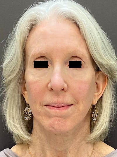 Facelift & Necklift Before & After Gallery - Patient 454356 - Image 2
