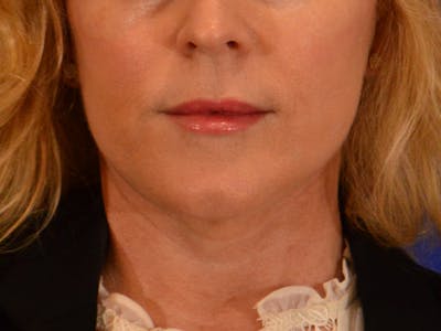 Facelift & Necklift Before & After Gallery - Patient 654569 - Image 2