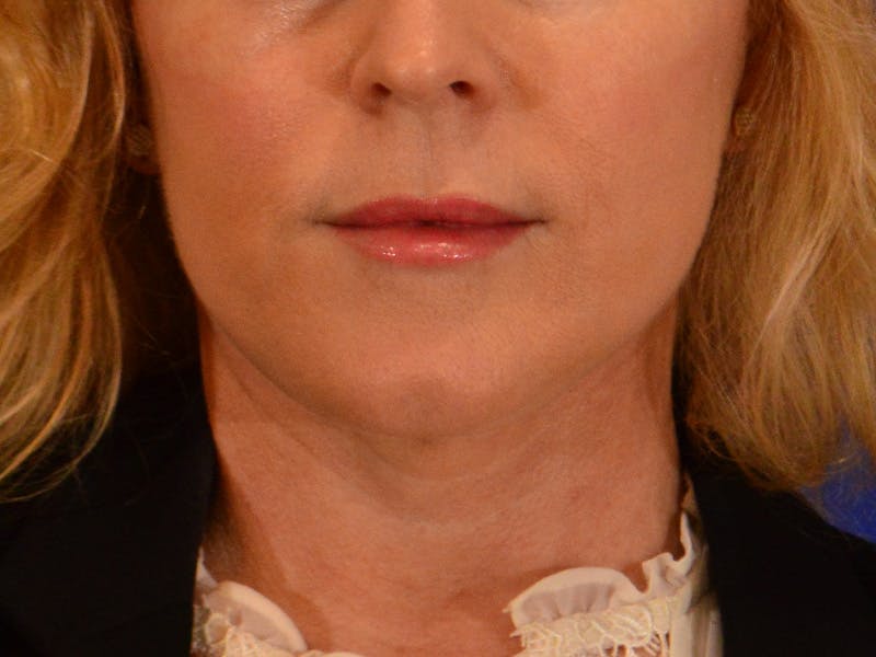 Facelift & Necklift Before & After Gallery - Patient 654569 - Image 2