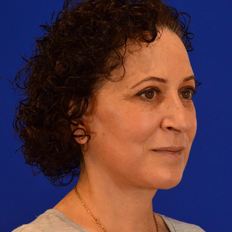 Facelift & Necklift Before & After Gallery - Patient 217555 - Image 4