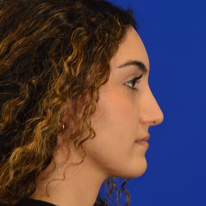 Female Rhinoplasty Before & After Gallery - Patient 224146 - Image 4