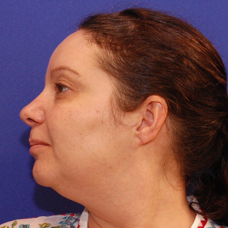 Facelift & Necklift Before & After Gallery - Patient 922406 - Image 9