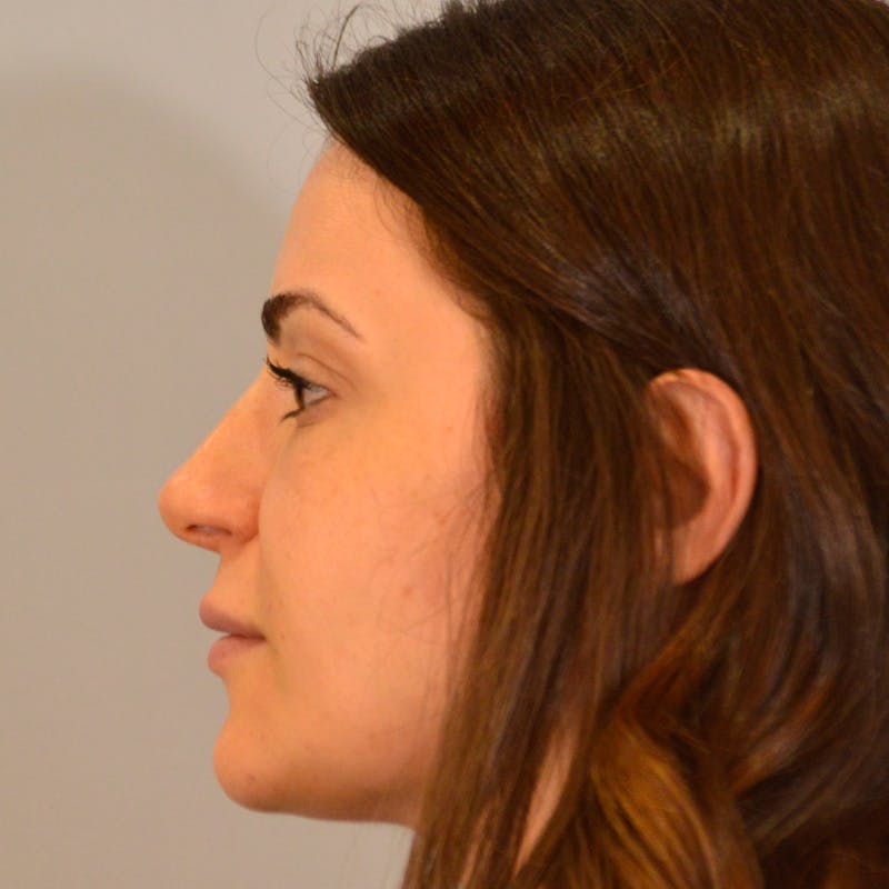 Dorsal Hump Before & After Gallery - Patient 911758 - Image 2