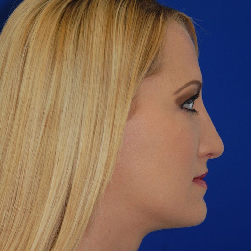 Long Nose Before & After Gallery - Patient 151681 - Image 6
