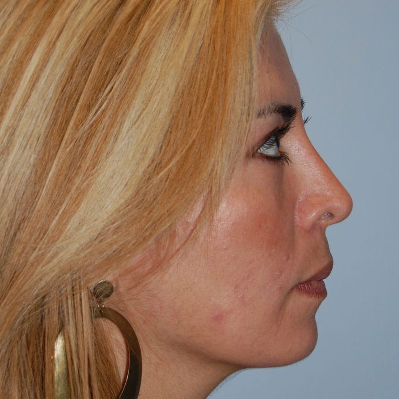 Crooked Nose Before & After Gallery - Patient 303792 - Image 6