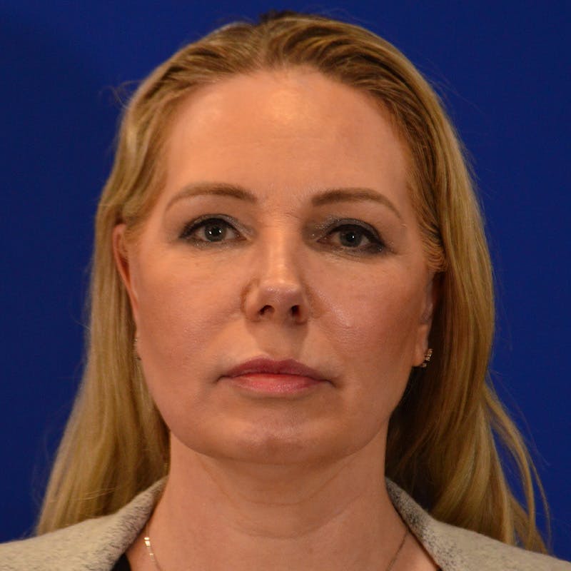 Revision Rhinoplasty Before & After Gallery - Patient 156468 - Image 5