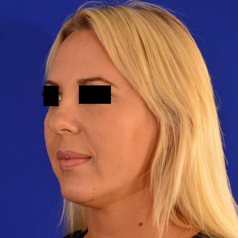 Wide Nose Before & After Gallery - Patient 306616 - Image 7