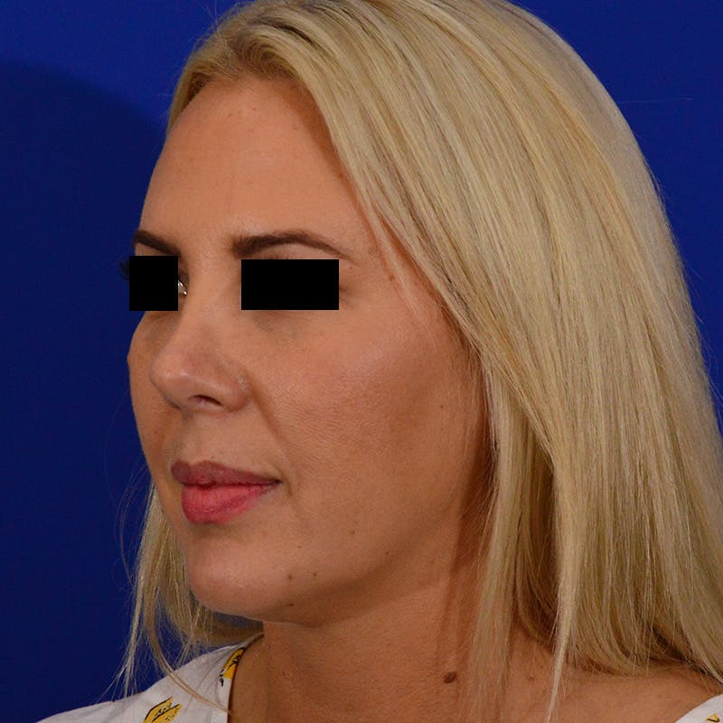 Wide Nose Before & After Gallery - Patient 306616 - Image 8