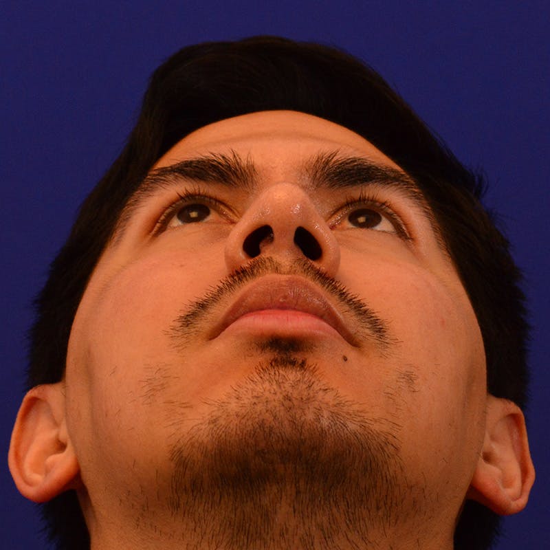 Chin Augmentation Before & After Gallery - Patient 332242 - Image 12