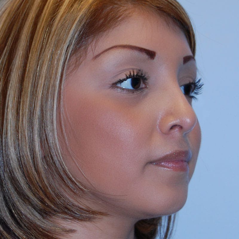 Long Nose Before & After Gallery - Patient 404621 - Image 4