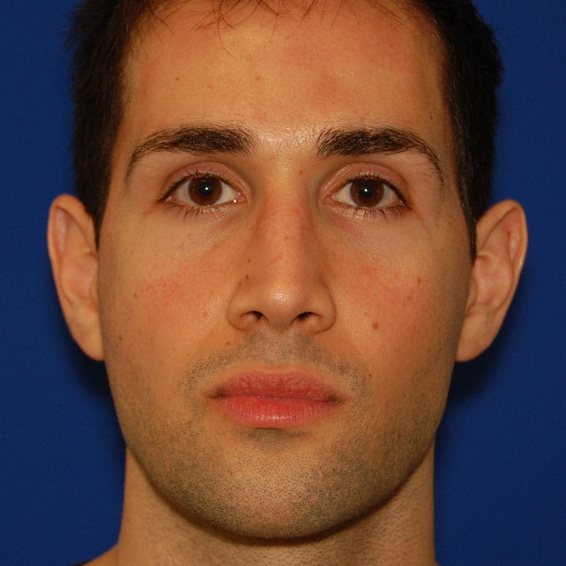 Crooked Nose Before & After Gallery - Patient 164777 - Image 2
