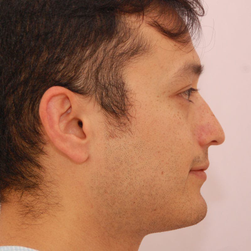 Ethnic Rhinoplasty Before & After Gallery - Patient 408370 - Image 1