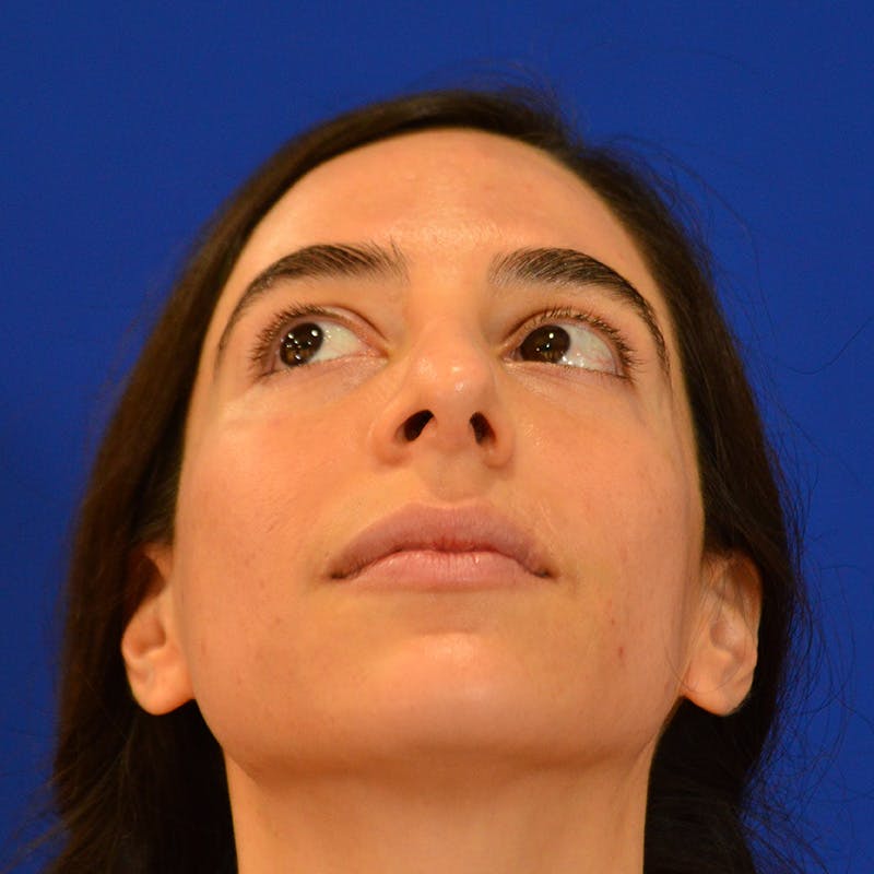 Facial Fat Grafting Before & After Gallery - Patient 411676 - Image 11