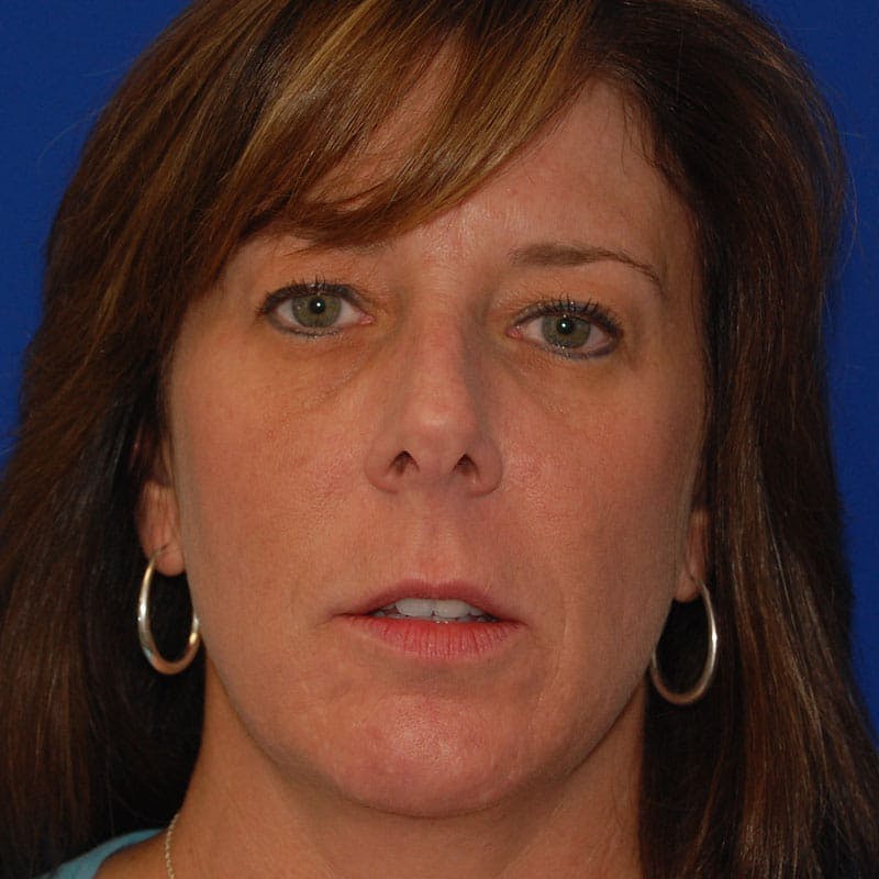 Dorsal Hump Before & After Gallery - Patient 255130 - Image 3