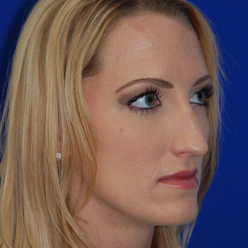 Long Nose Before & After Gallery - Patient 151681 - Image 3