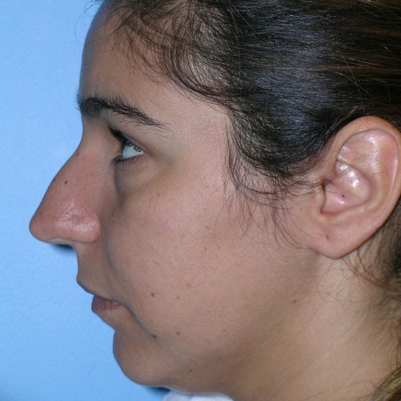 Long Nose Before & After Gallery - Patient 292085 - Image 5