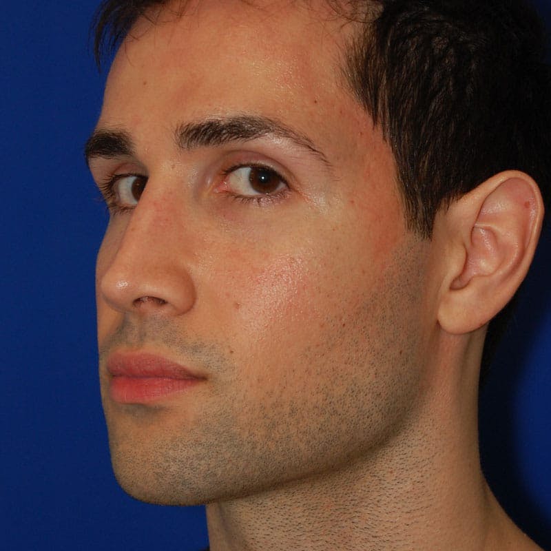 Crooked Nose Before & After Gallery - Patient 164777 - Image 4