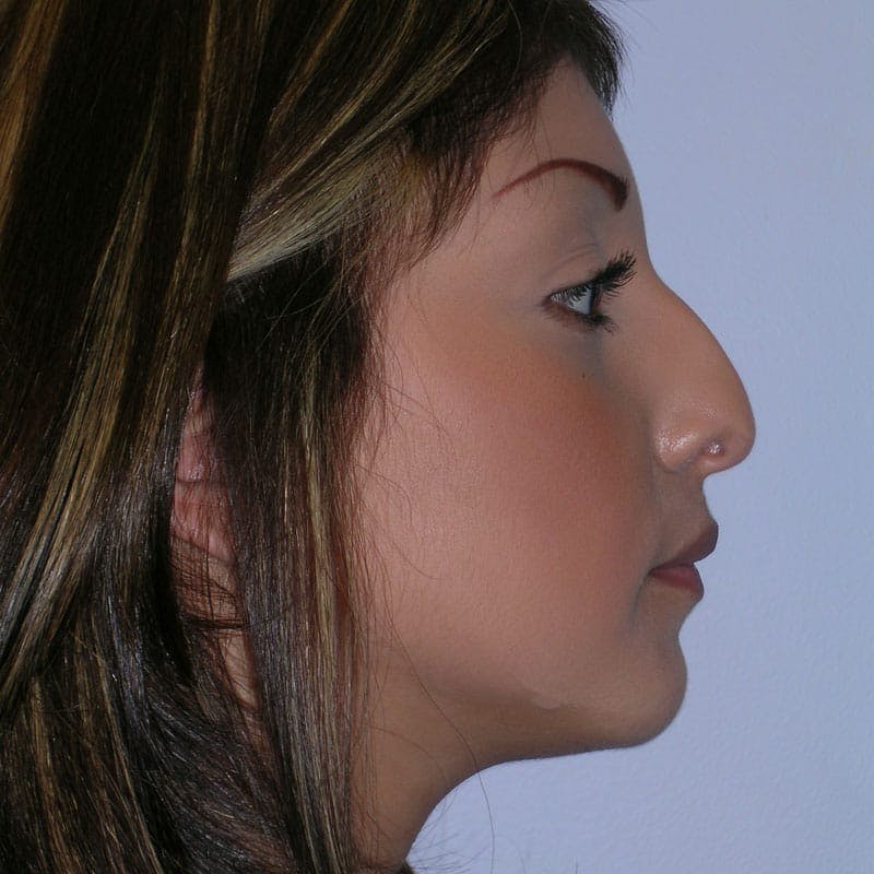 Long Nose Before & After Gallery - Patient 404621 - Image 5
