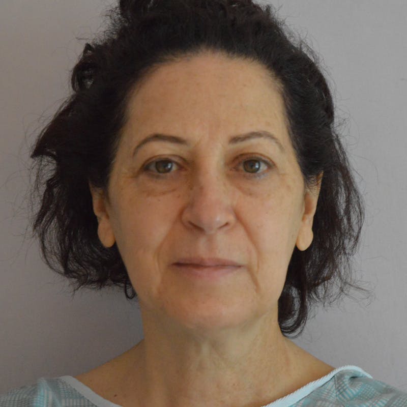 Facelift & Necklift Before & After Gallery - Patient 217555 - Image 1