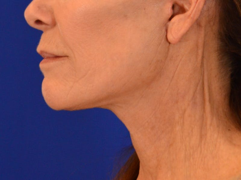 Facelift & Necklift Before & After Gallery - Patient 181377 - Image 10