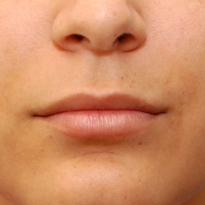 Lip Filler Before & After Gallery - Patient 289604 - Image 1