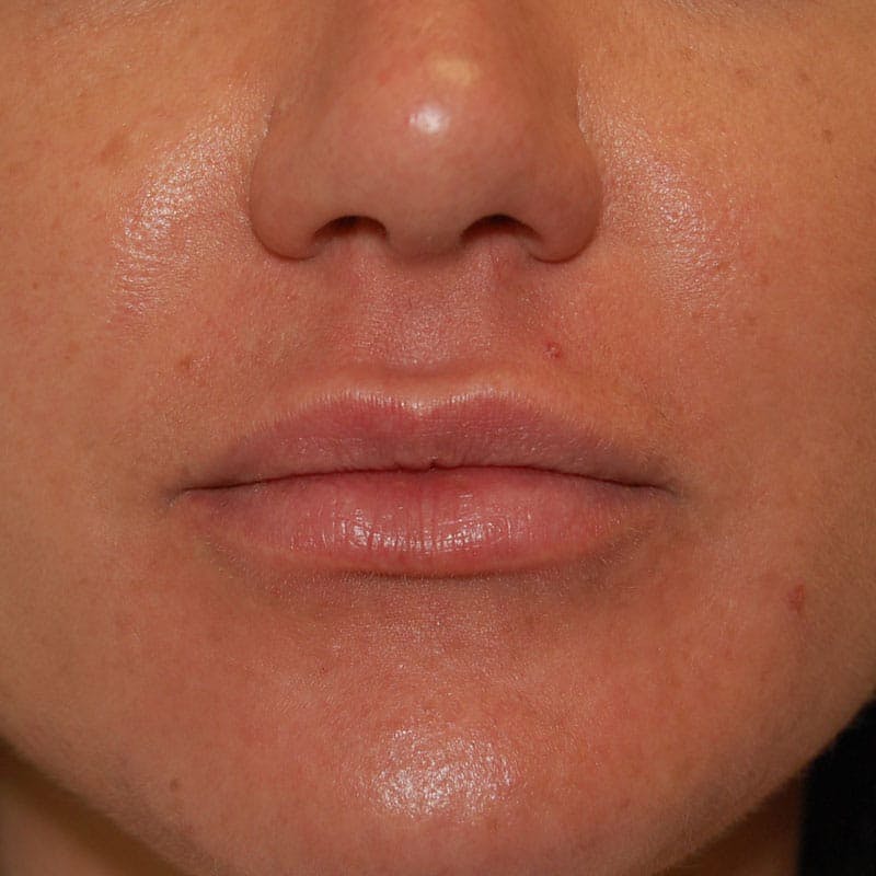 Lip Filler Before & After Gallery - Patient 317981 - Image 2