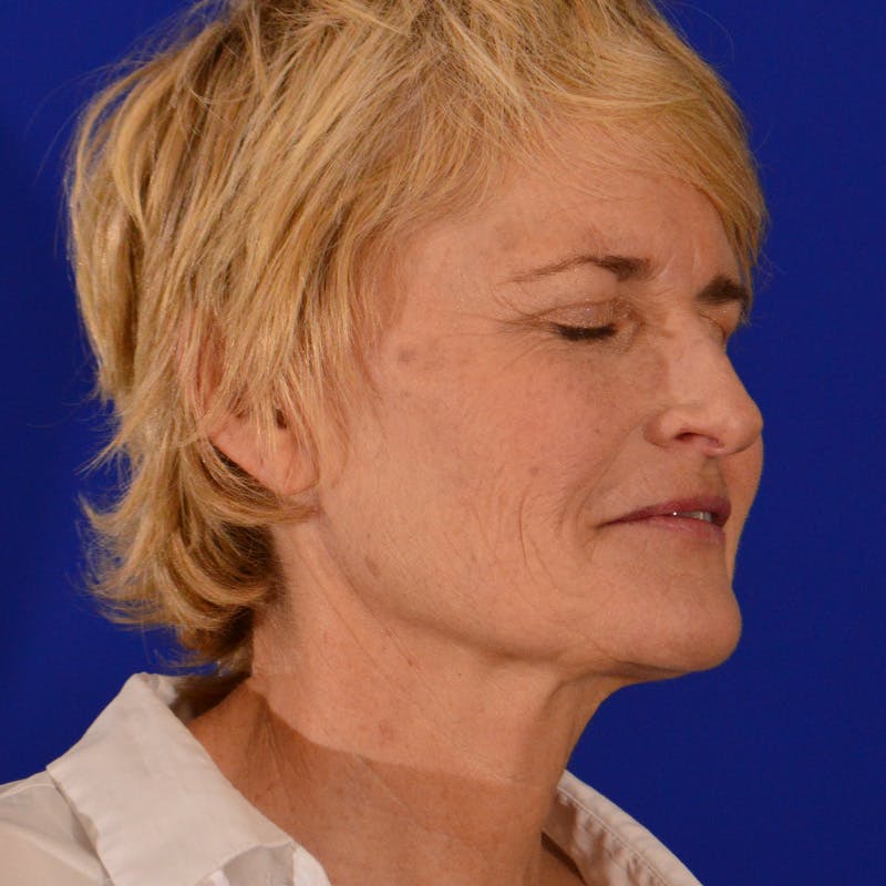 Co2 Laser Resurfacing Before & After Gallery - Patient 380986 - Image 3