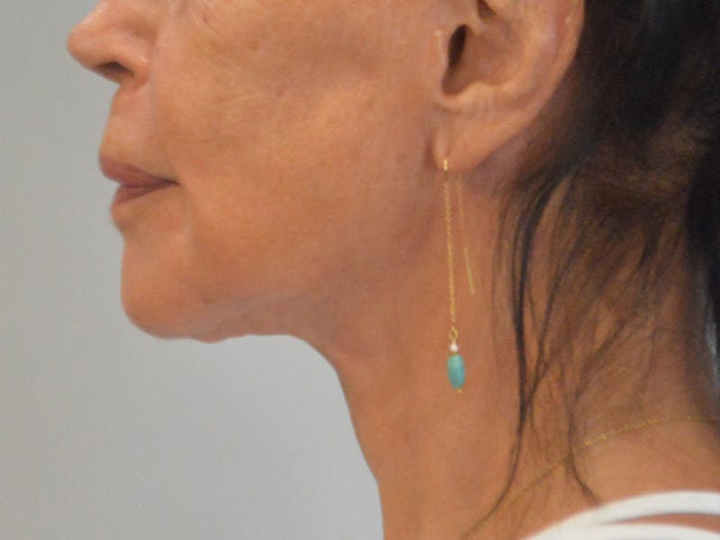 Facelift & Necklift Before & After Gallery - Patient 262546 - Image 2