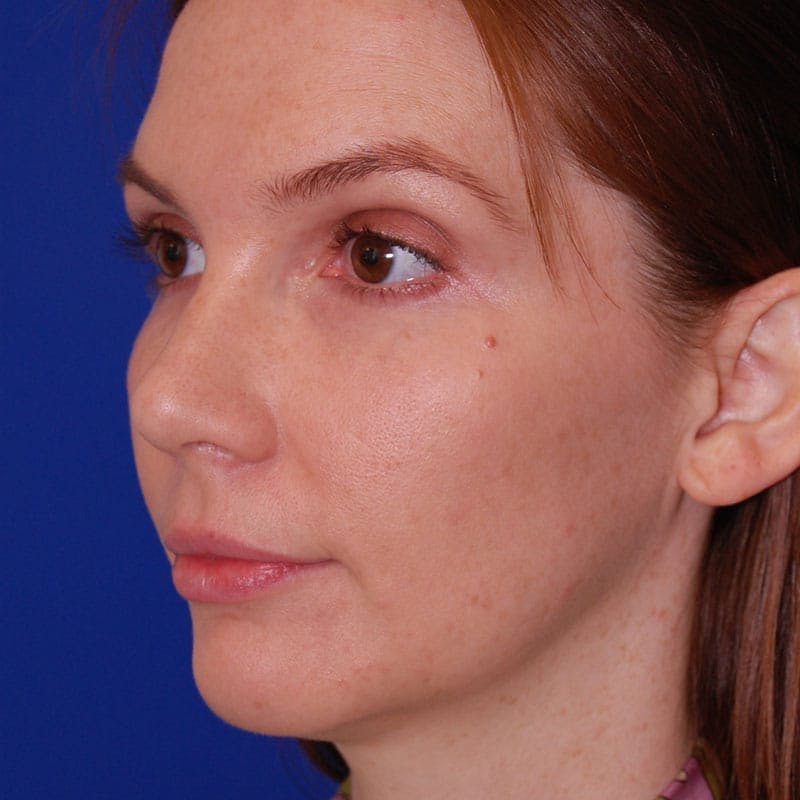 Crooked Nose Before & After Gallery - Patient 803322 - Image 4