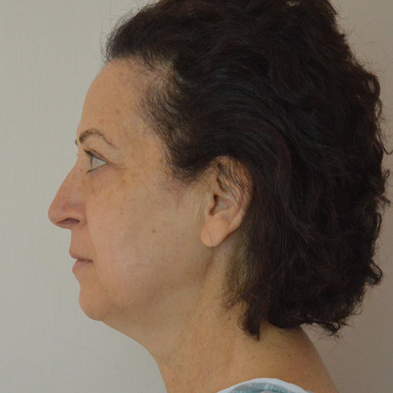 Facelift & Necklift Before & After Gallery - Patient 217555 - Image 9