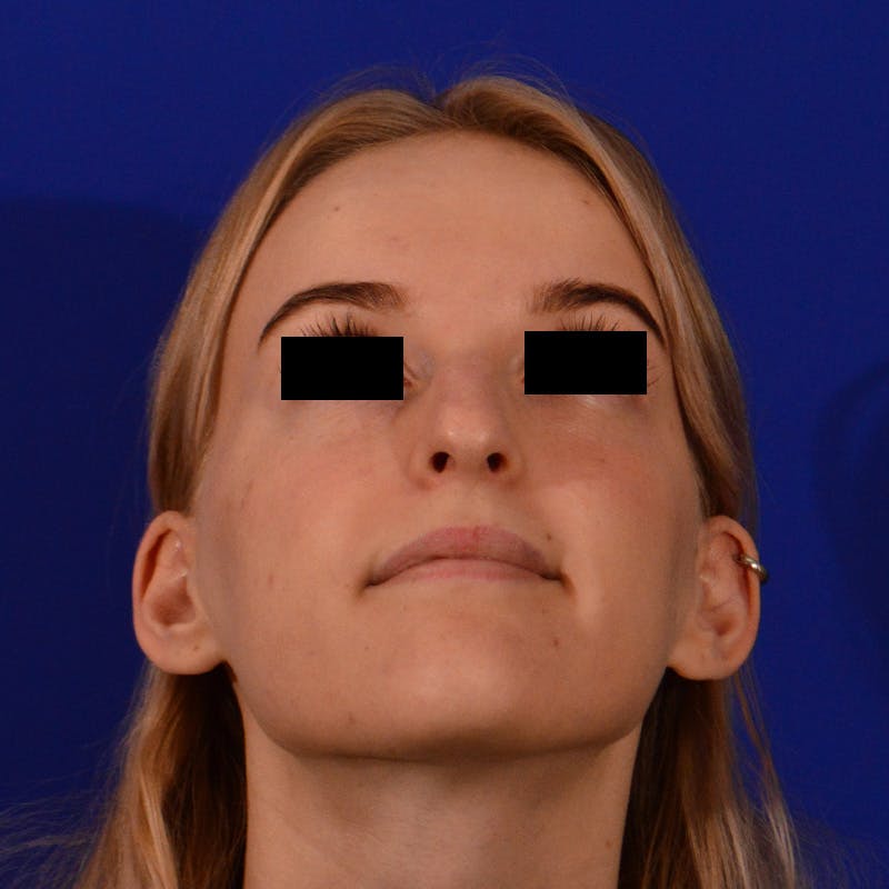Female Rhinoplasty Before & After Gallery - Patient 124593 - Image 11