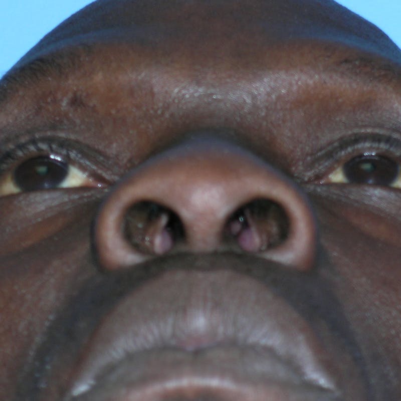 Wide Nose Before & After Gallery - Patient 129259 - Image 11