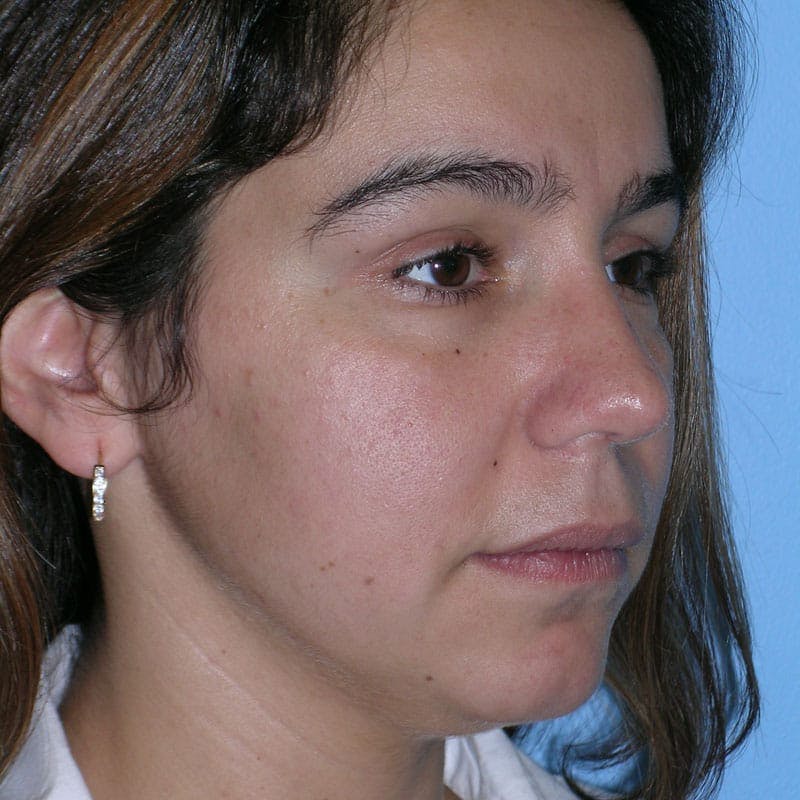 Long Nose Before & After Gallery - Patient 292085 - Image 4