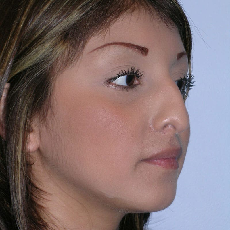 Long Nose Before & After Gallery - Patient 404621 - Image 3